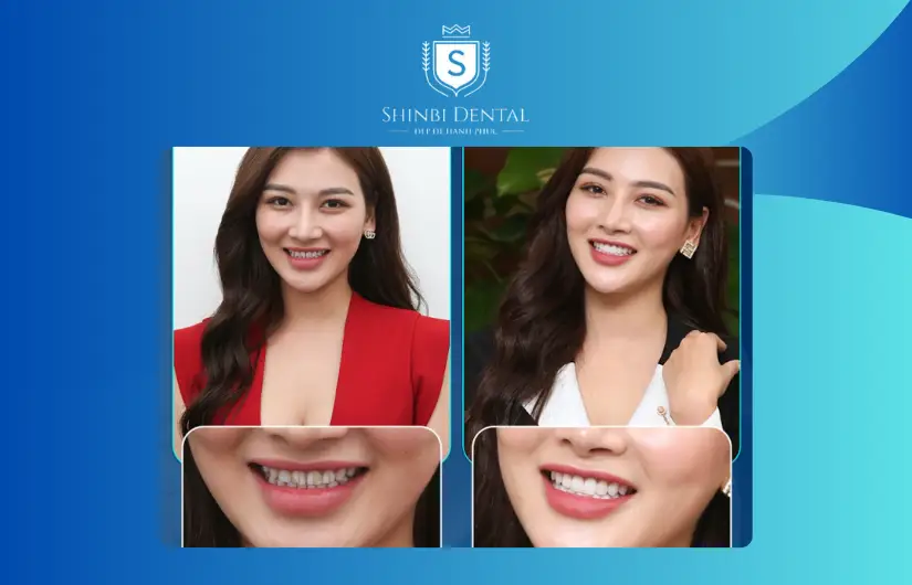 Ảnh trước và sau bọc răng 1