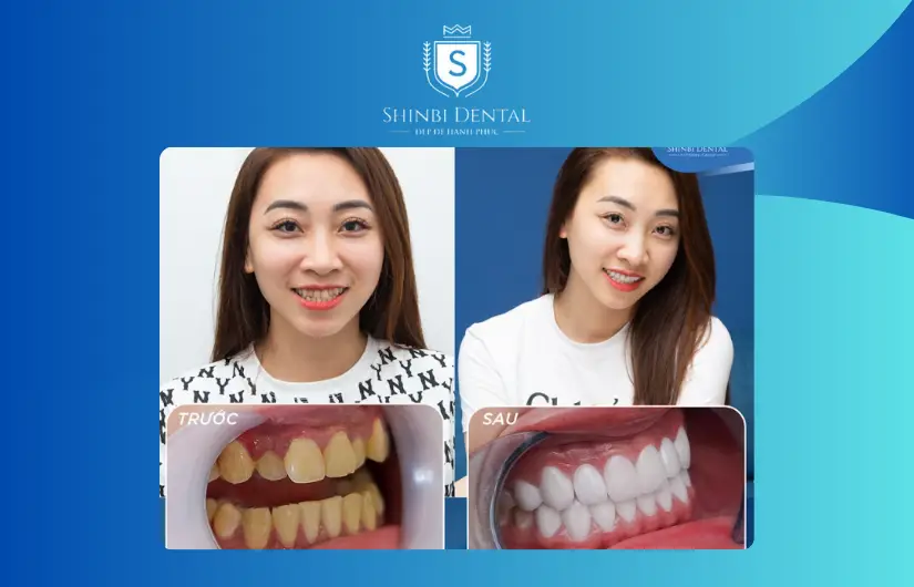 Ảnh trước và sau bọc răng 2