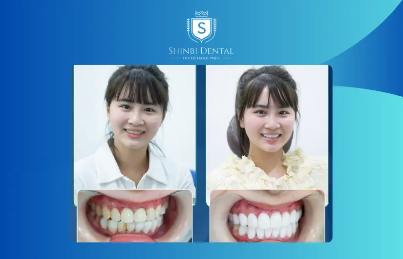 Ảnh trước và sau bọc răng 3