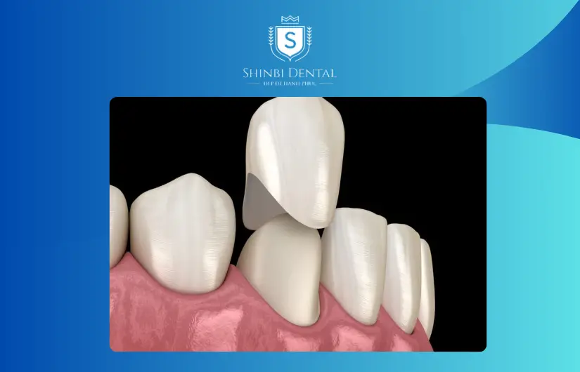 Các phương pháp bọc răng sứ Các phương pháp bọc răng sứ