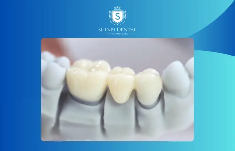 Cầu răng sứ bị ảnh hưởng bởi số lượng mão răng sứ Cầu răng sứ bị ảnh hưởng bởi số lượng mão răng sứ