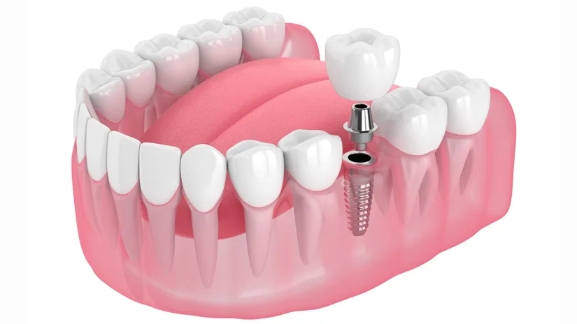 Cấy ghép Implant là gì? Lợi ích và Quy trình thực hiện