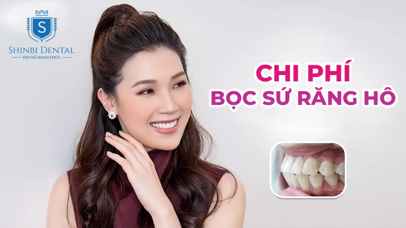 Chi phí bọc răng sứ cho răng hô bao nhiêu tiền? Bảng giá