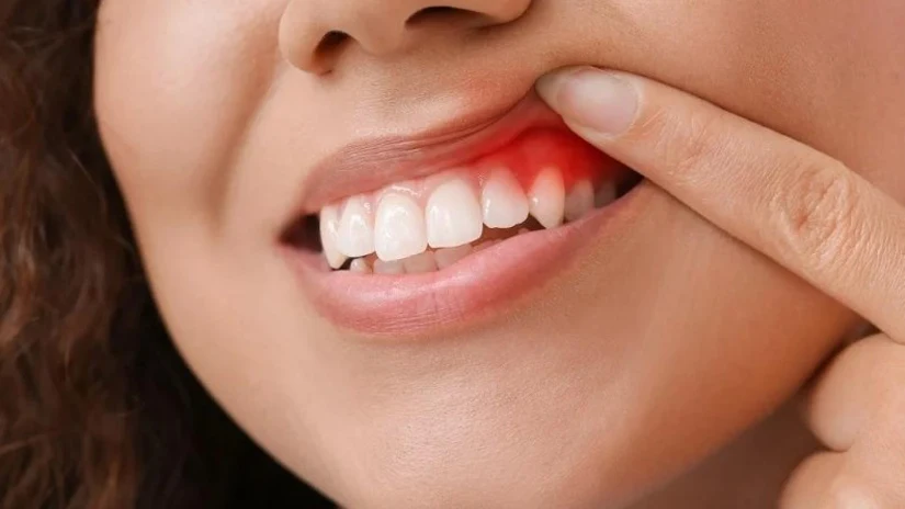 cú sốc nướu