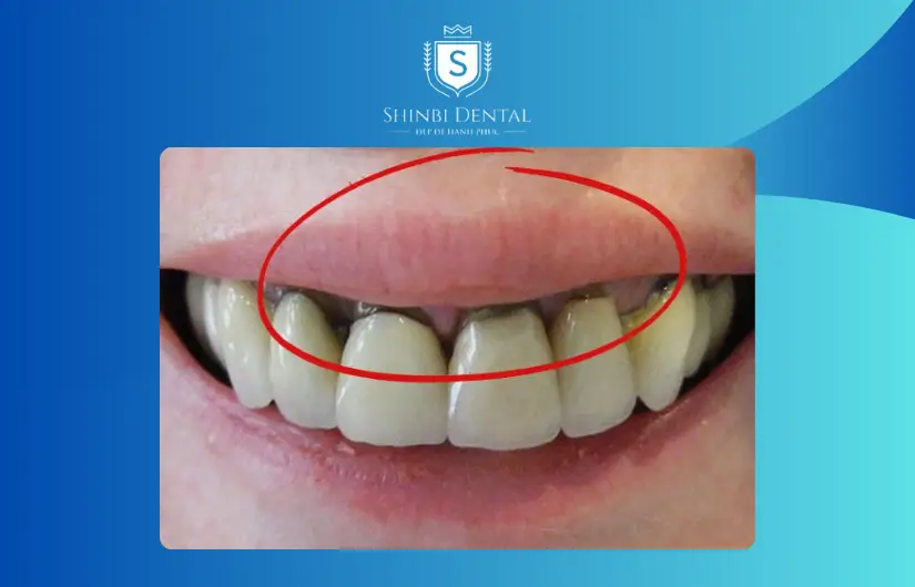 Đen viền nướu răng khi bọc răng sứ giá 500k Đen viền nướu răng khi bọc răng sứ giá 500k