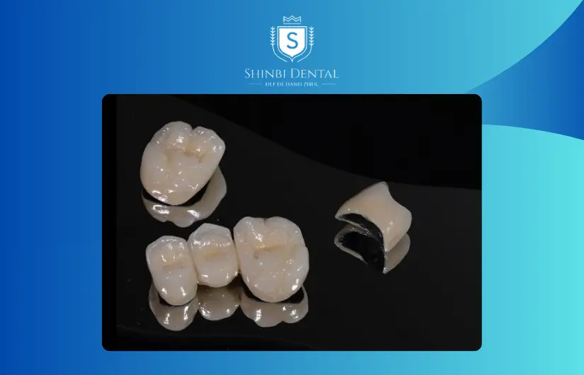 Giá bọc răng sứ bị ảnh hưởng bởi loại răng sứ