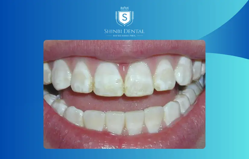 Giá bọc răng sứ bị ảnh hưởng bởi tình trạng răng