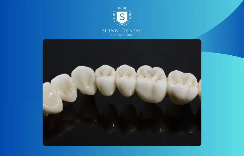 Răng sứ Venus là gì Răng sứ Venus là gì