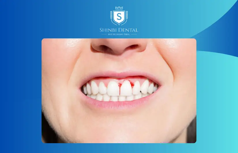 Không nên bọc răng sứ giá rẻ