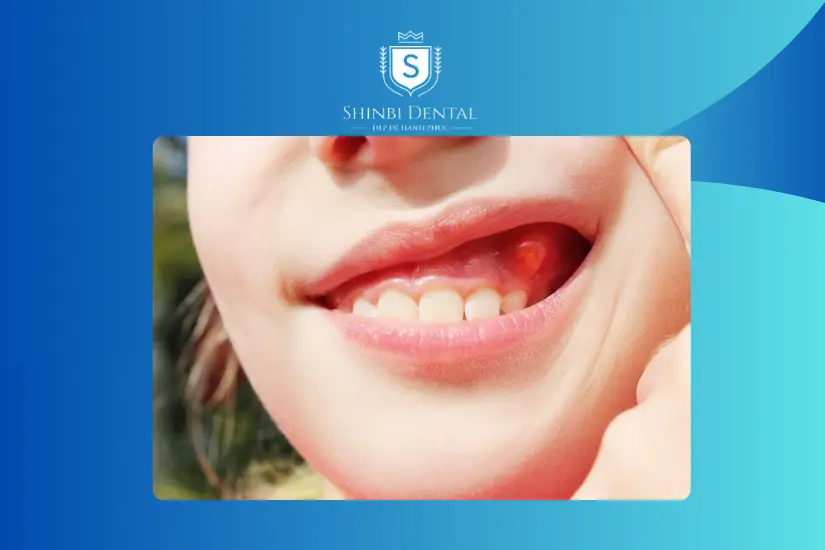 Kích ứng nướu sau khi tẩy trắng răng