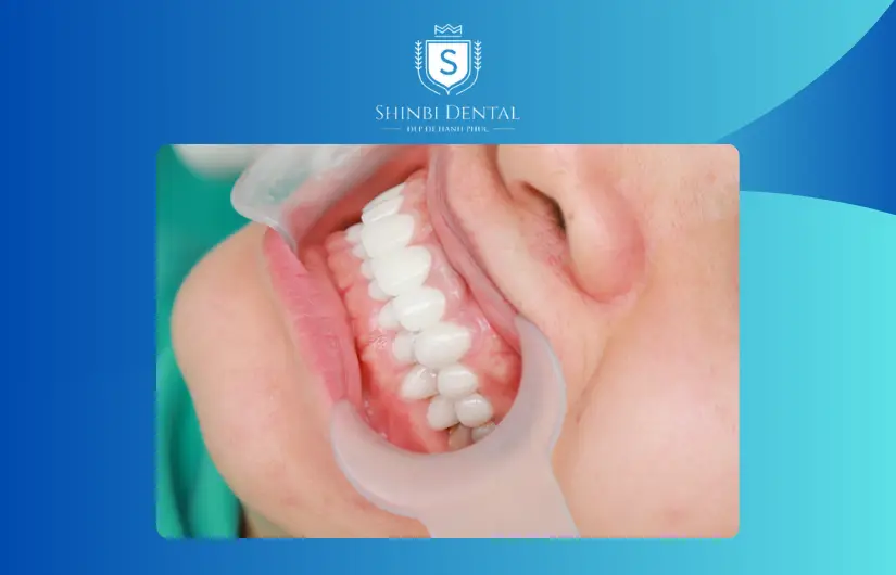 Kiểm tra nha khoa định kỳ Kiểm tra nha khoa định kỳ