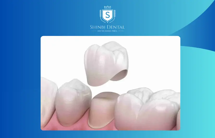 Lắp mão răng sứ