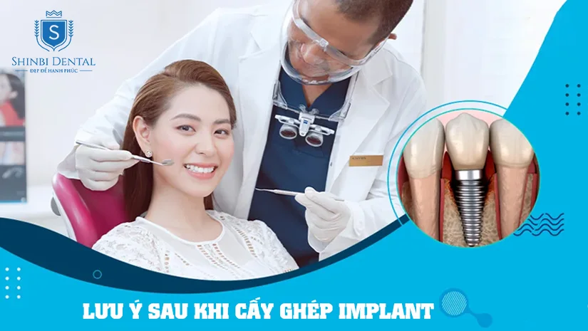 Lưu ý sau khi cấy ghép Implant