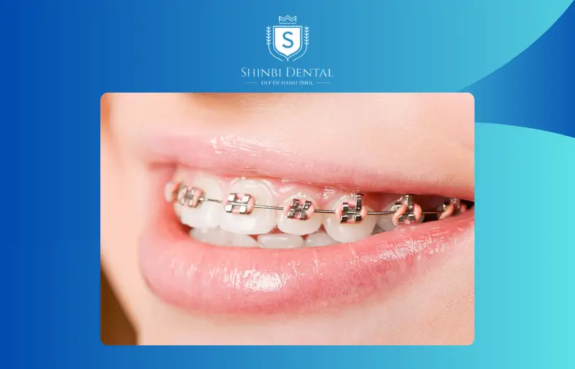 Ưu điểm của niềng răng cho răng hô Ưu điểm của niềng răng cho răng hô