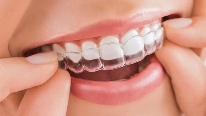 Niềng răng không có mắc cài Niềng răng không có mắc cài