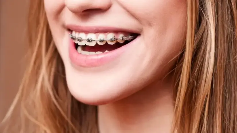 Niềng răng sử dụng mắc cài truyền thống Niềng răng sử dụng mắc cài truyền thống