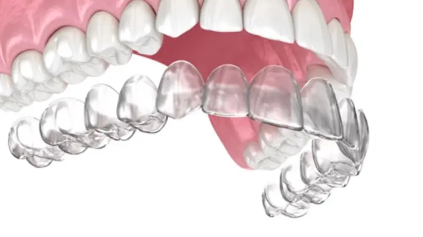 Niềng răng tại nha khoa Shinbi Niềng răng tại nha khoa Shinbi