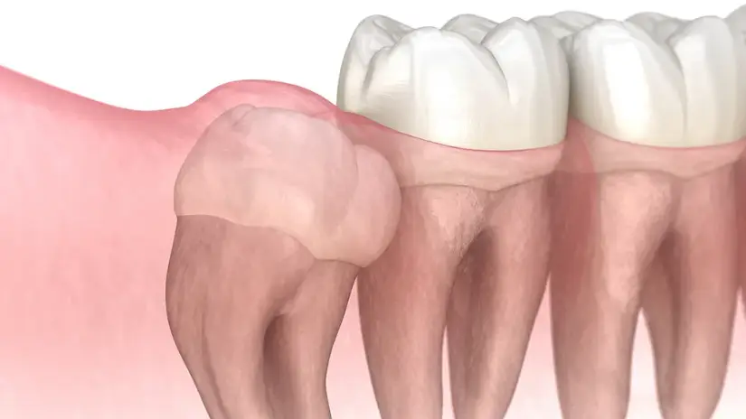 Răng khôn nằm ẩn hoàn toàn trong nướu