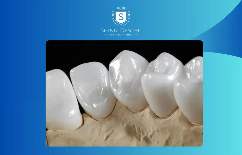 Răng sứ E.Max Răng sứ E Max