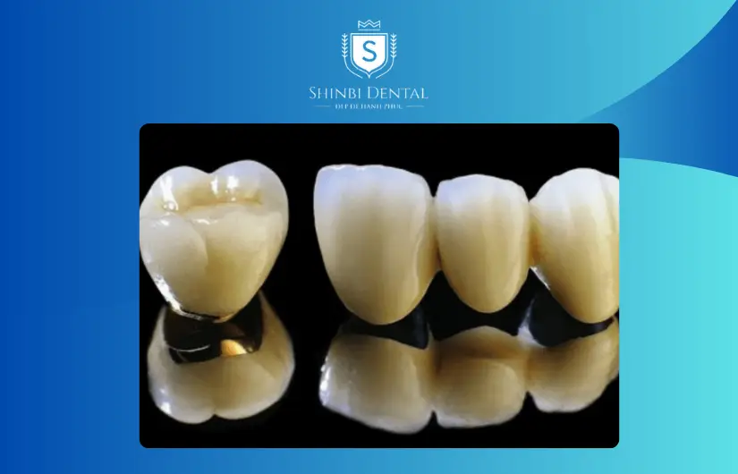 Răng sứ kim loại thường Răng sứ kim loại thường