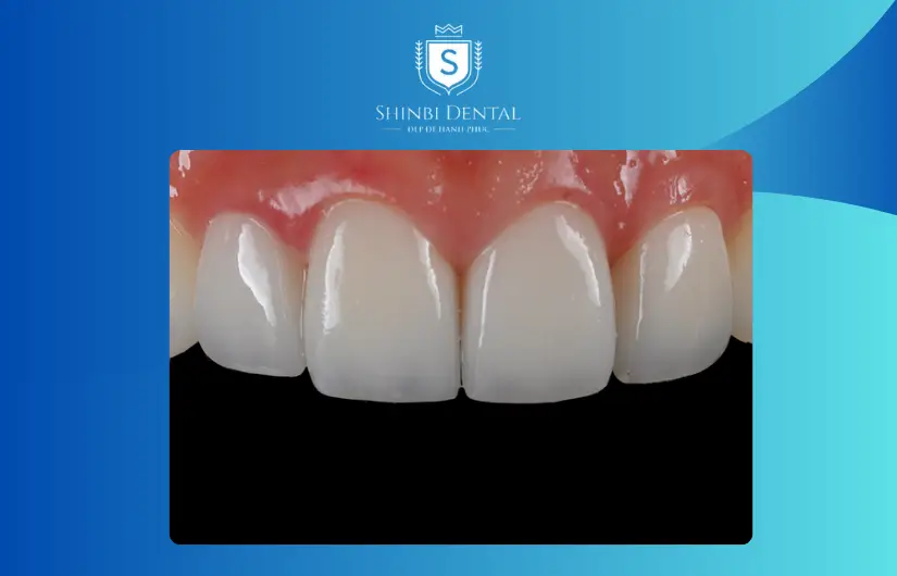 Giá bị ảnh hưởng bởi số lượng răng sứ cần bọc Giá bị ảnh hưởng bởi số lượng răng sứ cần bọc