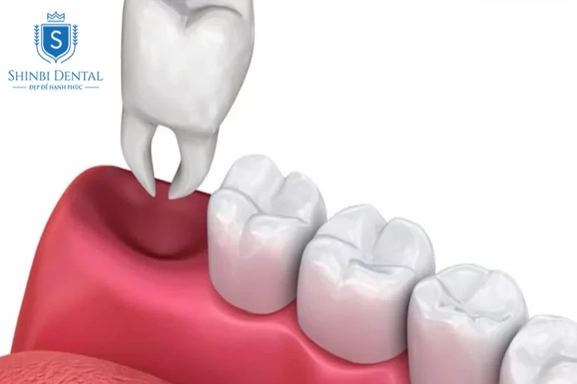 Tại sao lại hình thành lỗ sau khi nhổ răng khôn? Tại sao lại hình thành lỗ sau khi nhổ răng khôn?