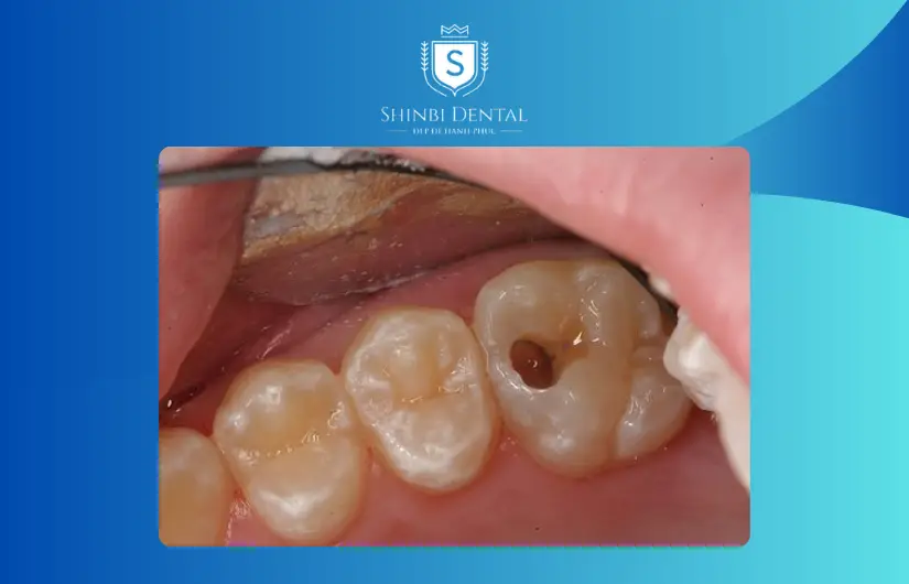 Tình trạng răng ảnh hưởng tới chi phí