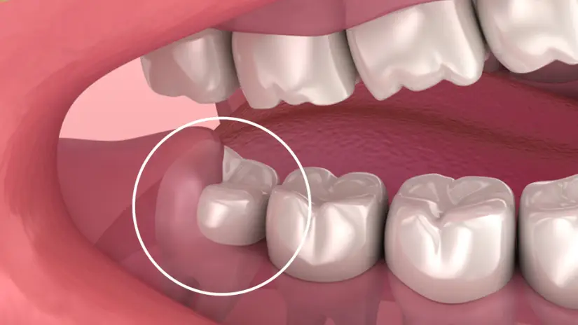 Trường hợp không cần nhổ răng khôn