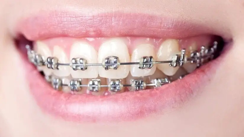 Ưu điểm của niềng răng thẩm mỹ Ưu điểm của niềng răng thẩm mỹ