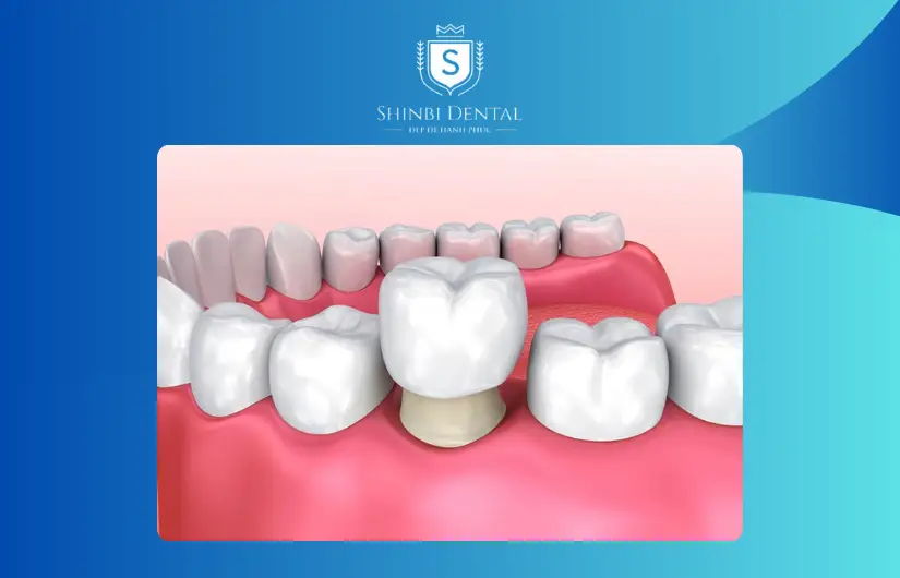 Các yếu tố tác động tới chi phí bọc răng sứ cho răng hô Các yếu tố tác động tới chi phí bọc răng sứ cho răng hô