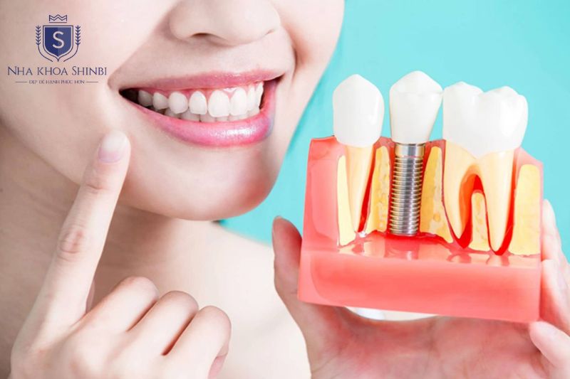 Bảo hành implant phụ thuộc hãng trụ và cần ghi rõ trong hợp đồng điều trị