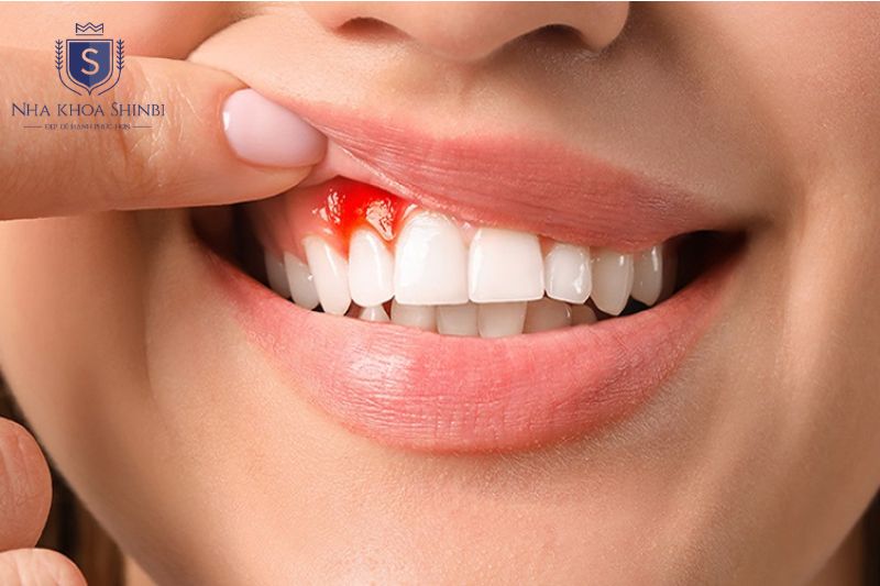 Biến chứng chảy máu và tổn thương thần kinh có thể phòng tránh bằng phân tích CBCT trước cấy implant