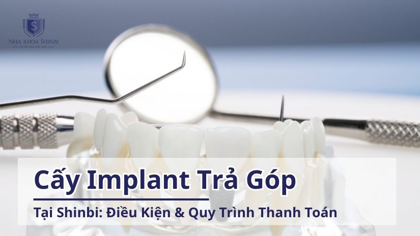 Cấy Implant Trả Góp tại Nha Khoa Shinbi: Điều Kiện & Quy Trình Thanh Toán