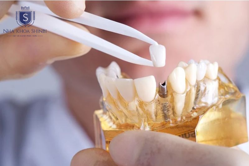 Cấy implant tại Shinbi dùng trụ chính hãng quy trình chuẩn và bác sĩ trực tiếp thực hiện 