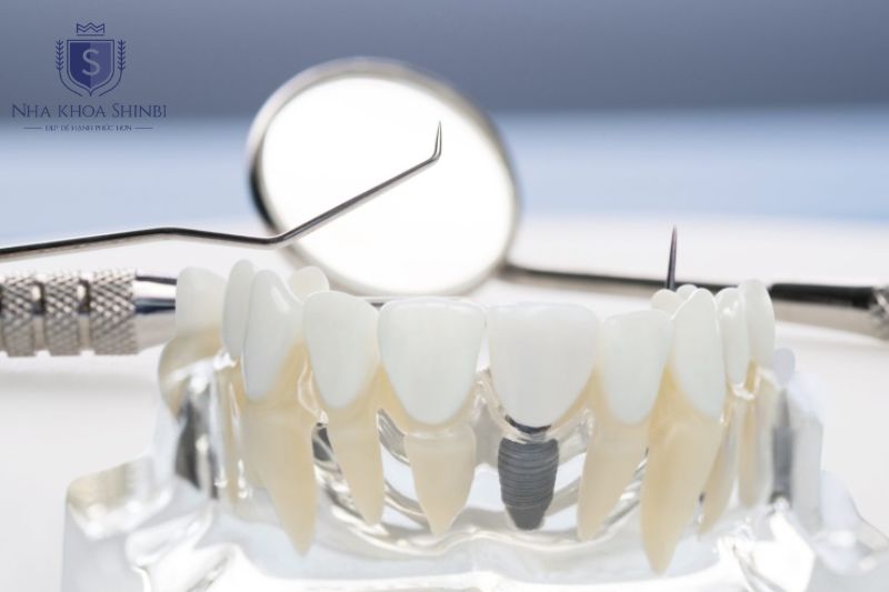 Cấy implant trả góp chia nhỏ chi phí, không ảnh hưởng chất lượng điều trị