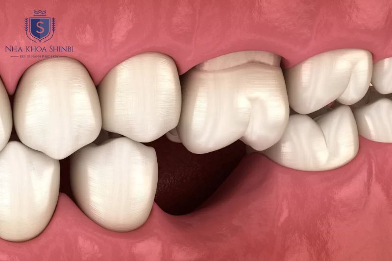 Cấy implant trả góp giúp phục hình sớm, hạn chế tiêu xương hàm và tăng hiệu quả điều trị 
