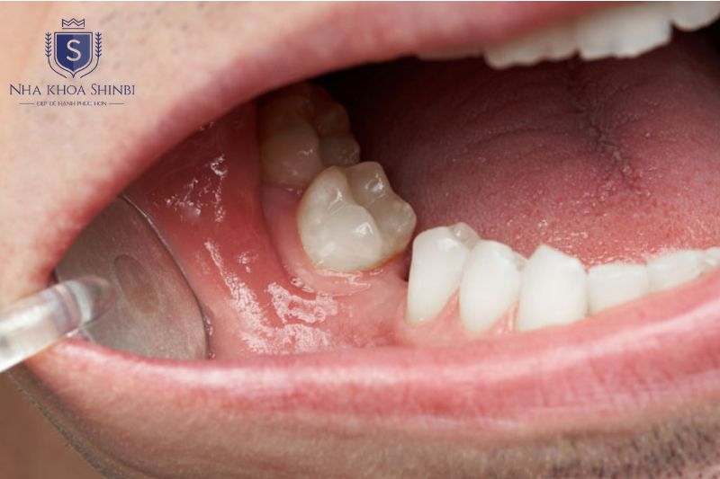 Chi phí cấy implant phụ thuộc xương hàm số trụ và loại mão sứ lựa chọn 