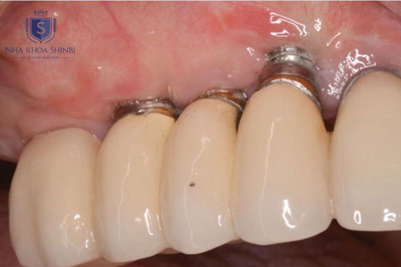 Đào thải trụ implant làm tăng chi phí và kéo dài điều trị do cần phẫu thuật lại