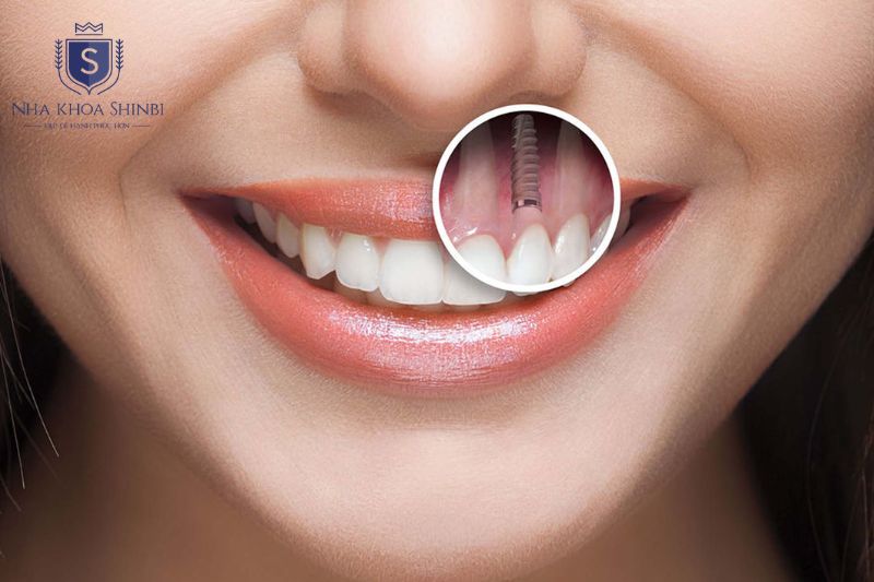 Giá implant 2026 dao động theo loại trụ và cảnh báo rủi ro từ dịch vụ quá rẻ