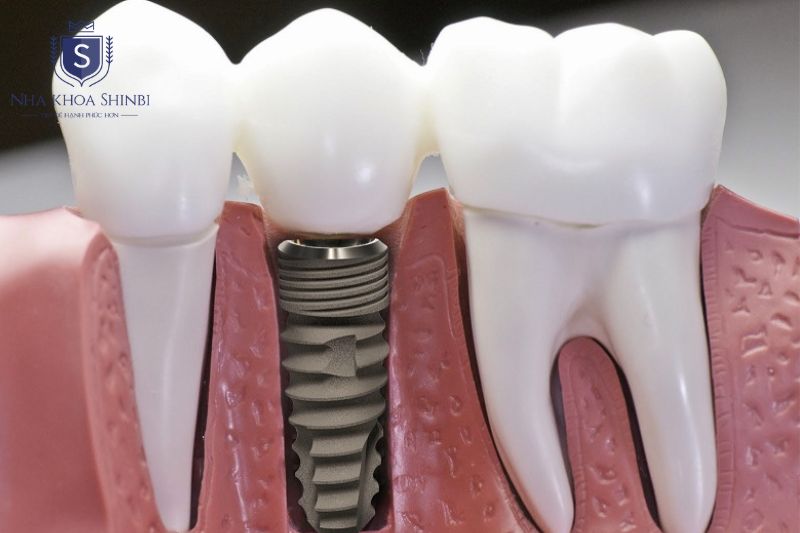 Giai đoạn 1 thanh toán 70 phần trăm khi cấy trụ implant bao gồm phẫu thuật và vật liệu 