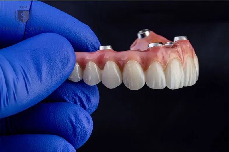 Implant All on 4 và All on 6 tại Shinbi áp dụng trả góp 70 30 theo hai giai đoạn