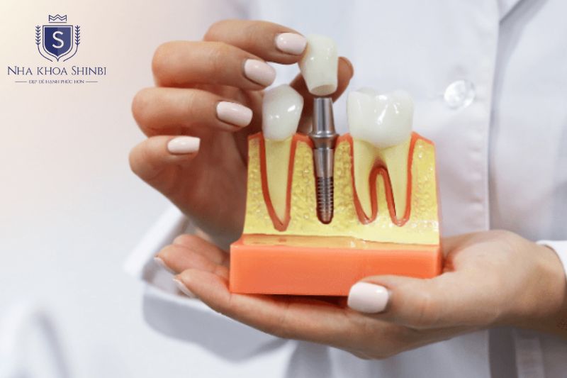 Implant giá tốt đảm bảo tiêu chuẩn y khoa đầy đủ với chi phí tối ưu và minh bạch