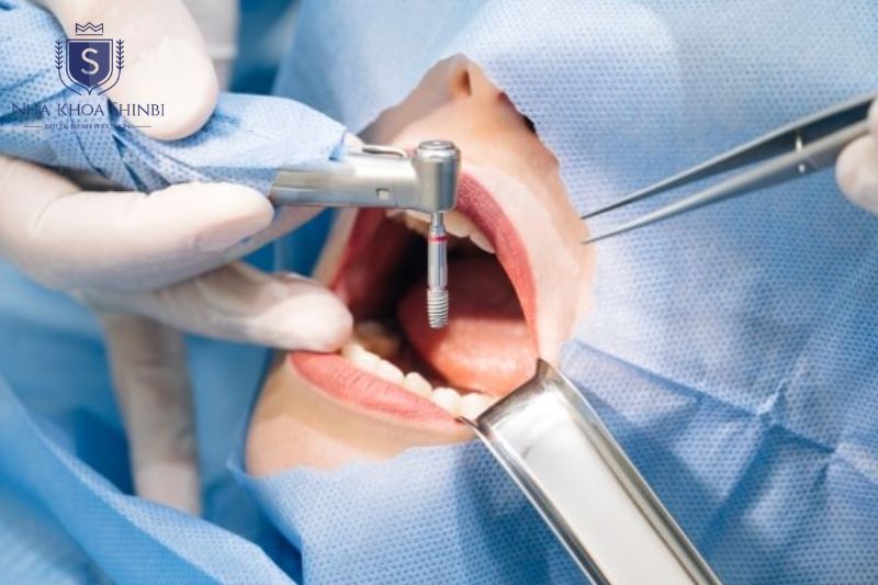 Implant tái tạo chân răng ngăn tiêu xương và bền hơn cầu răng sứ lâu dài