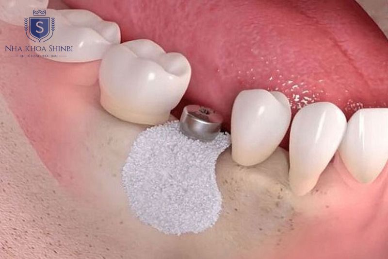 Mất răng lâu năm gây tiêu xương hàm cần ghép xương trước hoặc khi cấy implant