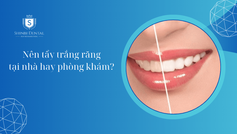 Nên tẩy trắng răng tại nhà hay phòng khám? [Hỏi – Đáp]