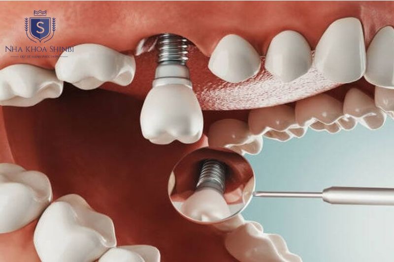 Trả góp implant khác implant giá rẻ, đảm bảo chất lượng trong khi chia nhỏ chi phí 