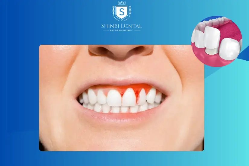 Bị nha chu không nên bọc răng sứ Bị nha chu không nên bọc răng sứ