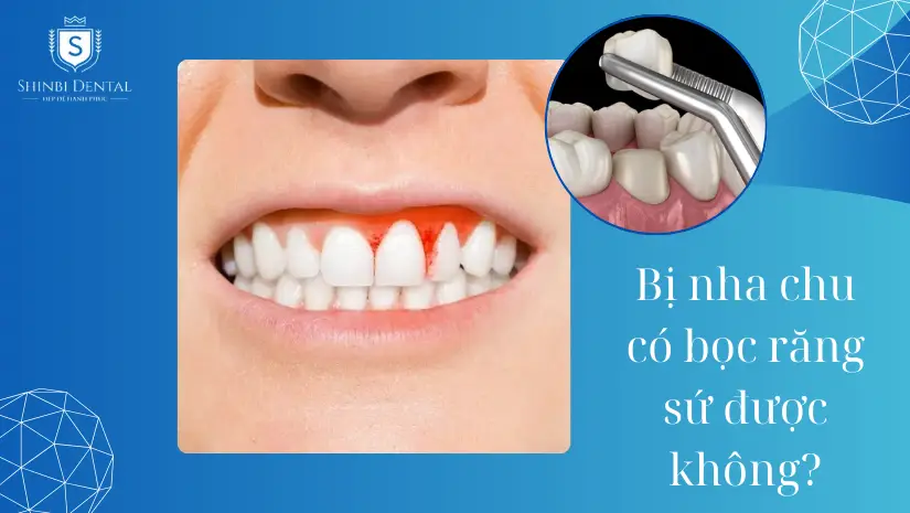 Bị nha chu có bọc răng sứ được không? [Bác sĩ giải đáp]