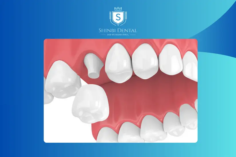 Dịch vụ bọc chụp răng sứ Dịch vụ bọc chụp răng sứ