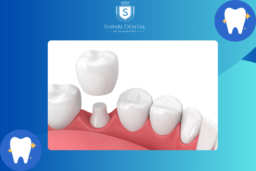 Bọc răng sứ 1 chiếc được Bọc răng sứ 1 chiếc được